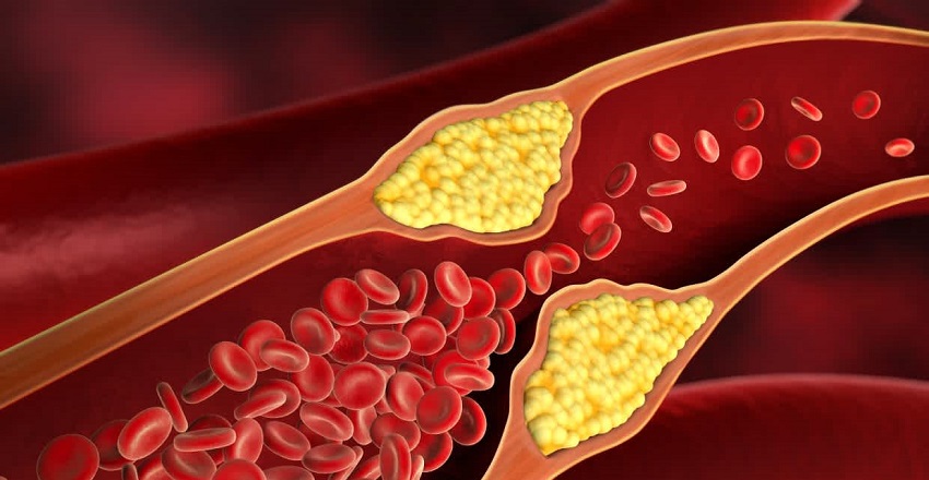 Cholesterol & Ayurveda: Understanding the Root Cause and Natural Healing